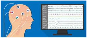 Neurofeedback